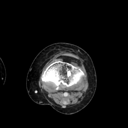 Chondrosarcoma - femur (Radiopaedia 64187-72954 Axial with contrast 60).jpg