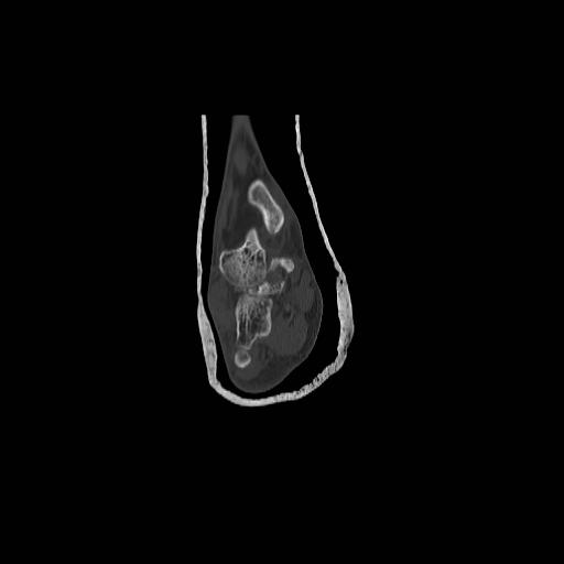 File:Chopart fracture (Radiopaedia 12386-12650 Coronal bone window 1).jpg