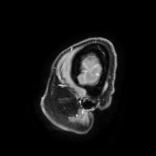 File:Chordoid glioma of third ventricle (Radiopaedia 91612-109340 F 191).jpg