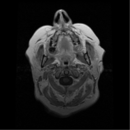 File:Choroid plexus papilloma (Radiopaedia 33040-34052 Axial T1 C+ 1).png