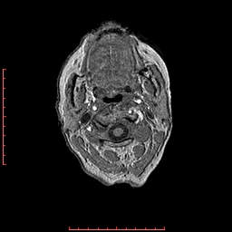 File:Choroid plexus xanthogranuloma (Radiopaedia 67843-77270 Axial T1 170).jpg