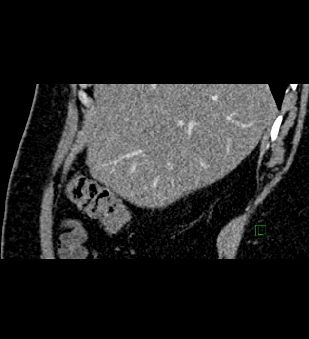 Chromophobe renal cell carcinoma (Radiopaedia 84286-99573 F 142).jpg