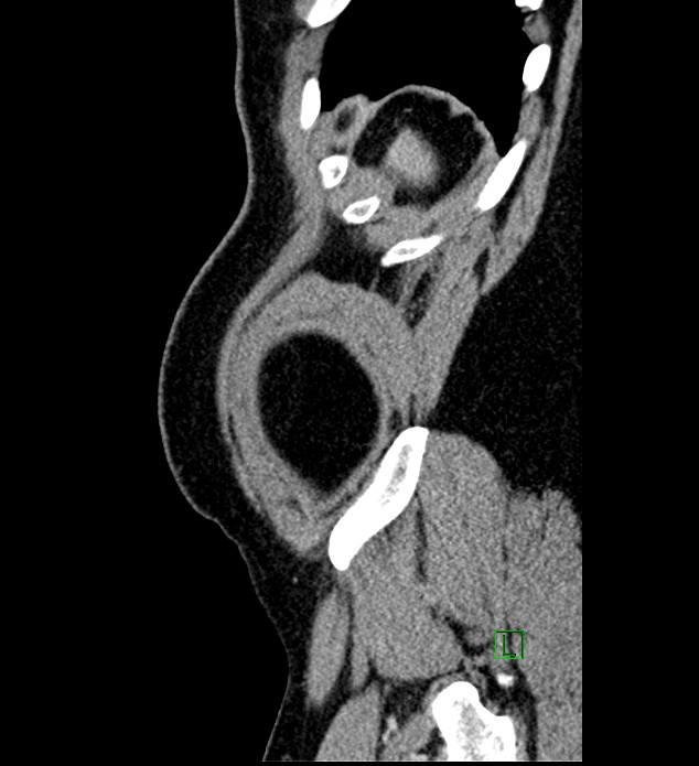 Chromophobe renal cell carcinoma (Radiopaedia 84286-99573 I 7).jpg