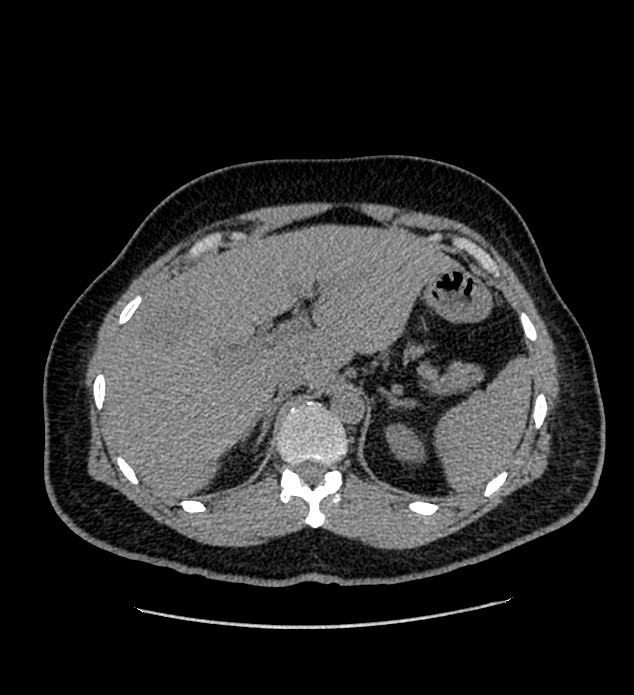 Chromophobe renal cell carcinoma (Radiopaedia 84337-99693 Axial non-contrast 27).jpg