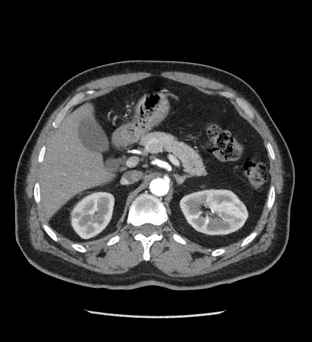 Chromophobe renal cell carcinoma (Radiopaedia 86879-103083 B 44).jpg