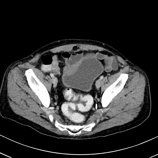 Chronic appendicitis complicated by appendicular abscess, pylephlebitis and liver abscess (Radiopaedia 54483-60700 B 123).jpg