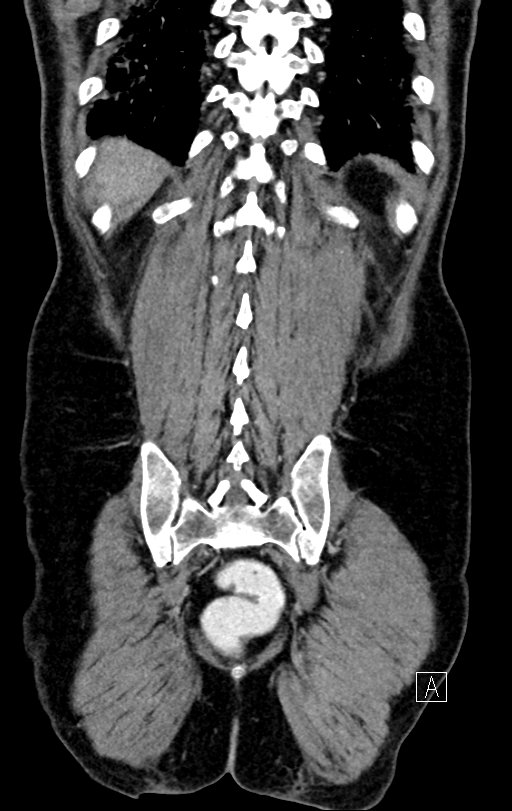 Chronic appendicitis complicated by appendicular abscess, pylephlebitis and liver abscess (Radiopaedia 54483-60700 C 70).jpg