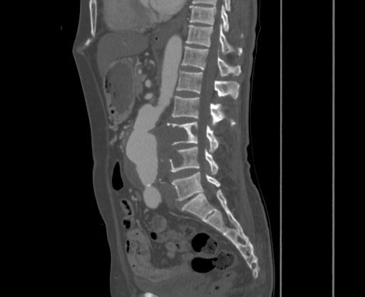File:Chronic contained rupture of abdominal aortic aneurysm with extensive erosion of the vertebral bodies (Radiopaedia 55450-61901 Sagittal bone window 23).jpg