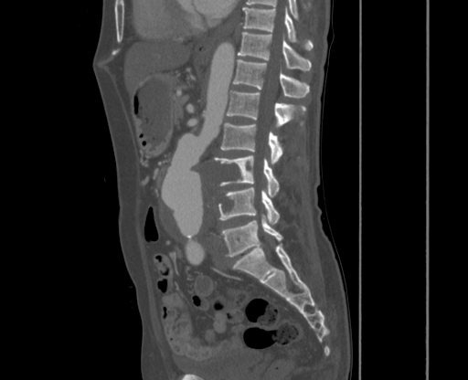 File:Chronic contained rupture of abdominal aortic aneurysm with extensive erosion of the vertebral bodies (Radiopaedia 55450-61901 Sagittal bone window 25).jpg