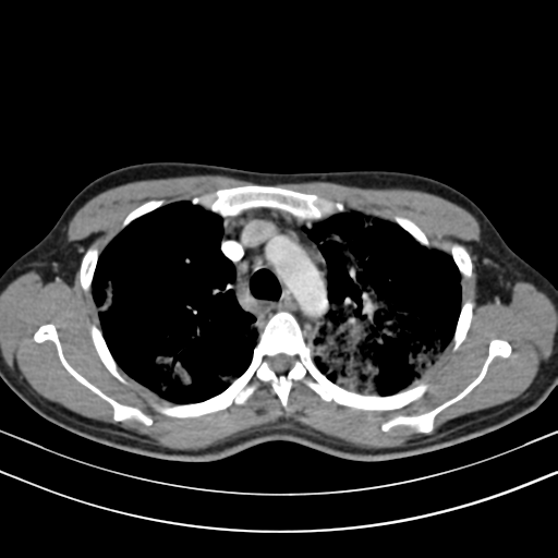 Chronic eosinophilic pneumonia (Radiopaedia 39331-41587 Axial C+ delayed 39).png