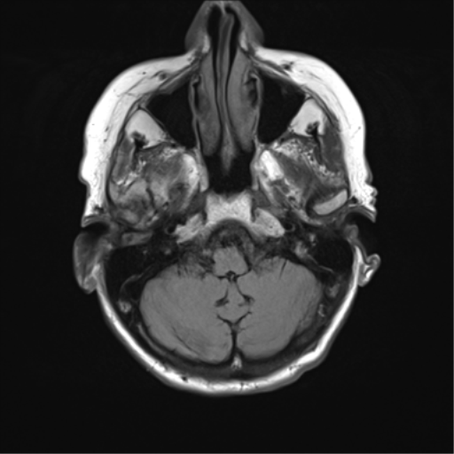 File:Chronic hypertensive encephalopathy (Radiopaedia 72844-83495 Axial FLAIR 4).png