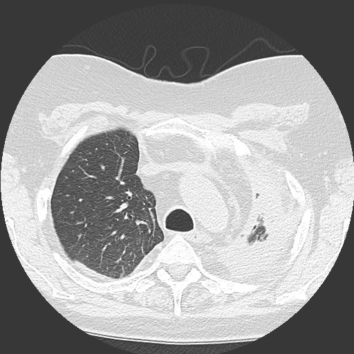 Chronic lung allograft dysfunction - restrictive form (Radiopaedia 60595-68316 Axial lung window 17).jpg