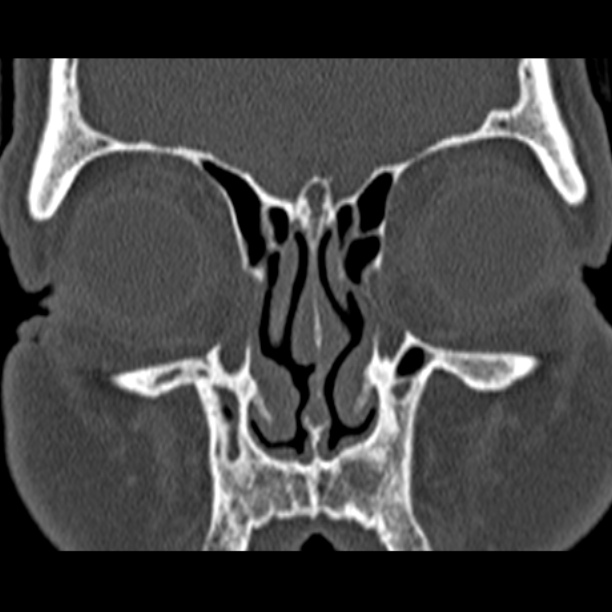 Chronic maxillary sinusitis (Radiopaedia 27879-28116 Coronal bone window 15).jpg