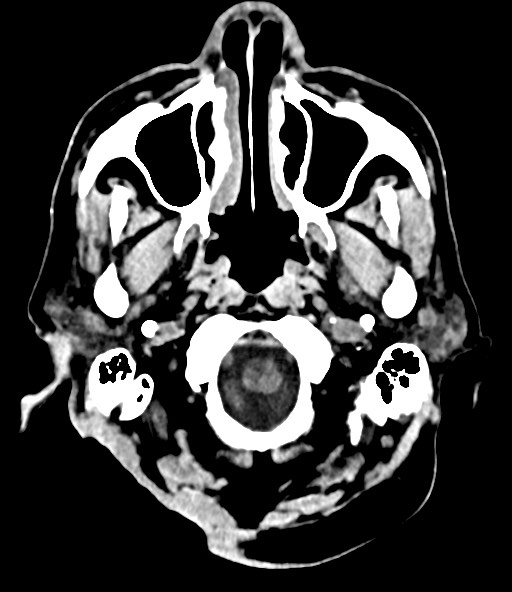 File:Chronic osteomyelitis - calvarial (severe) (Radiopaedia 69668-79616 Axial non-contrast 25).jpg