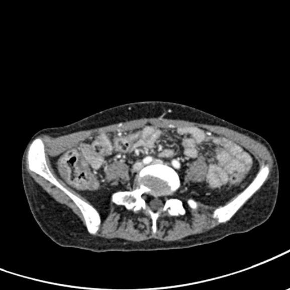 Chronic pancreatitis (Radiopaedia 55405-61846 A 70).jpg