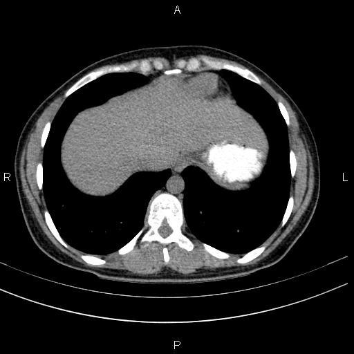 Chronic pancreatitis (Radiopaedia 64576-73450 Axial non-contrast 7).jpg