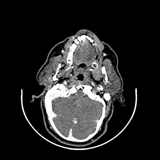 File:Chronic submandibular abscess (Radiopaedia 21738-21718 A 6).jpg