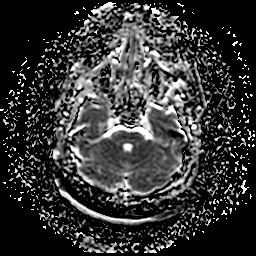 File:Chronic submandibular sialadenitis (Radiopaedia 61852-69885 Axial ADC 2).jpg