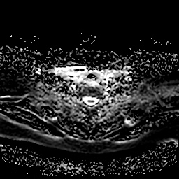 File:Chronic submandibular sialadenitis (Radiopaedia 61852-69885 Axial ADC 26).jpg