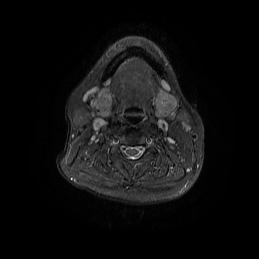 File:Chronic submandibular sialadenitis (Radiopaedia 61852-69885 Axial STIR 15).jpg