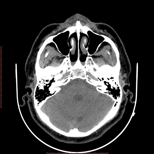 Chronic submandibular sialolithiasis (Radiopaedia 69817-79814 Axial non-contrast 1).jpg