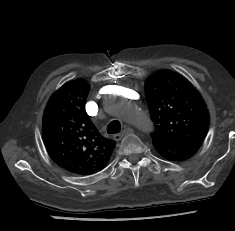 Chronic thromboembolic pulmonary disease (Radiopaedia 90694-108119 Axial C+ CTPA 25).jpg