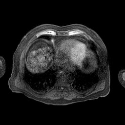 Cirrhosis and hepatocellular carcinoma in the setting of hemochromatosis (Radiopaedia 75394-86594 Axial T1 C+ fat sat 74).jpg