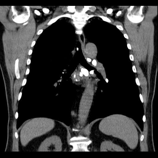 File:Classic complicated silicosis (Radiopaedia 49720-54961 Coronal liver window 38).jpg