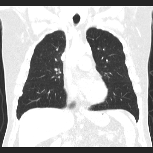 File:Classic complicated silicosis (Radiopaedia 49720-54961 Coronal lung window 26).jpg