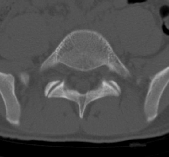 Clear cell meningoma - lumbar spine (Radiopaedia 60116-67691 Axial bone window 62).png