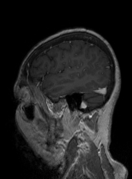 Clival meningioma (Radiopaedia 53278-59248 Sagittal T1 C+ 168).jpg