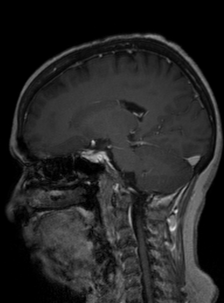 Clival meningioma (Radiopaedia 53278-59248 Sagittal T1 C+ 233).jpg