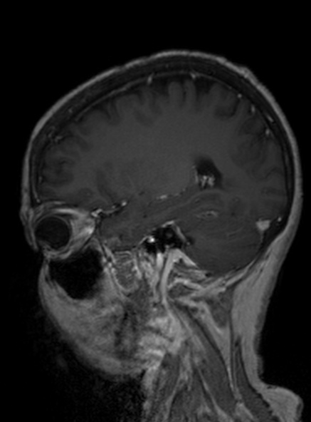 Clival meningioma (Radiopaedia 53278-59248 Sagittal T1 C+ 309).jpg