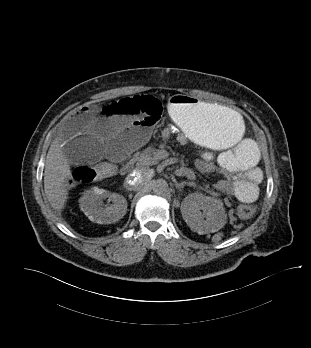 Closed-loop small bowel obstruction-internal hernia (Radiopaedia 78439-91096 Axial non-contrast 53).jpg