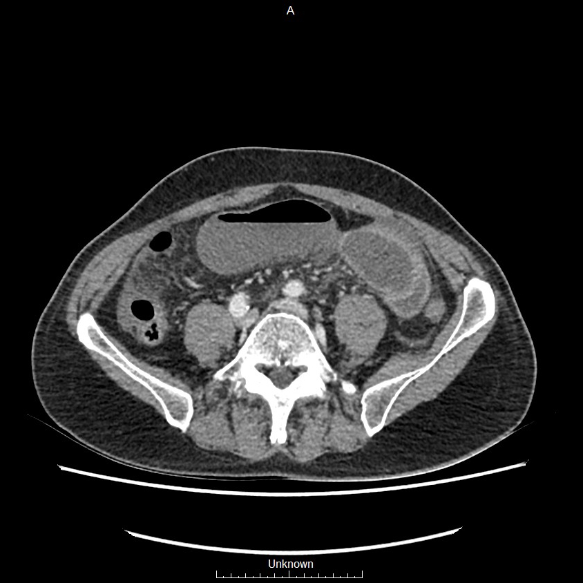 Closed loop bowel obstruction and ischemia (Radiopaedia 86959-103180 A 55).jpg