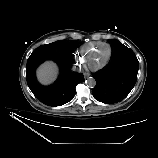 File:Closed loop obstruction due to adhesive band, resulting in small bowel ischemia and resection (Radiopaedia 83835-99023 Axial non-contrast 16).jpg