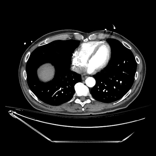 Closed loop obstruction due to adhesive band, resulting in small bowel ischemia and resection (Radiopaedia 83835-99023 B 13).jpg