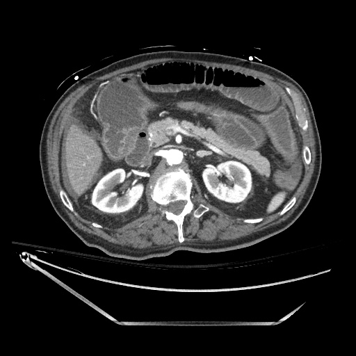 Closed loop obstruction due to adhesive band, resulting in small bowel ischemia and resection (Radiopaedia 83835-99023 B 56).jpg