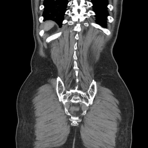 File:Closed loop obstruction due to adhesive band, resulting in small bowel ischemia and resection (Radiopaedia 83835-99023 C 108).jpg