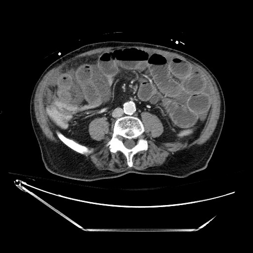 Closed loop obstruction due to adhesive band, resulting in small bowel ischemia and resection (Radiopaedia 83835-99023 D 91).jpg