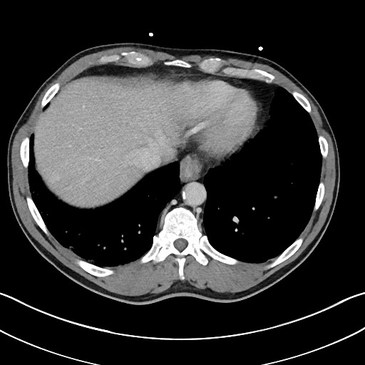 File:Closed loop small bowel obstruction - internal hernia (Radiopaedia 57806-64778 B 14).jpg