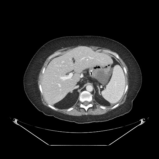 Closed loop small bowel obstruction - internal hernia (Radiopaedia 65402-74450 A 25).jpg