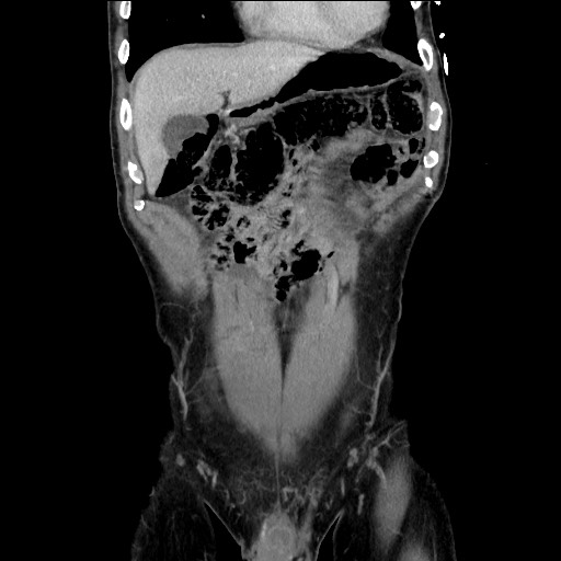 Closed loop small bowel obstruction - omental adhesion causing "internal hernia" (Radiopaedia 85129-100682 B 37).jpg