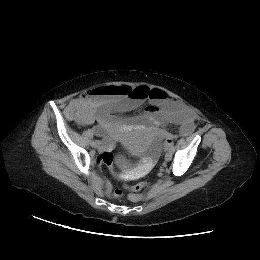 Closed loop small bowel obstruction due to adhesive band, with intramural hemorrhage and ischemia (Radiopaedia 83831-99017 Axial non-contrast 129).jpg