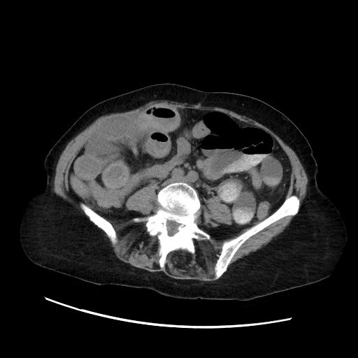 Closed loop small bowel obstruction due to adhesive band, with intramural hemorrhage and ischemia (Radiopaedia 83831-99017 Axial non-contrast 96).jpg