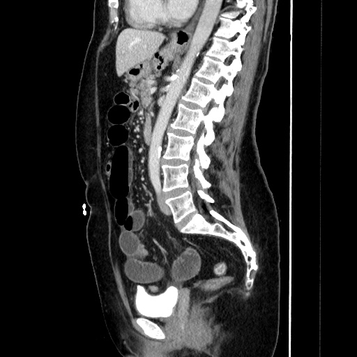 Closed loop small bowel obstruction due to adhesive bands - early and late images (Radiopaedia 83830-99015 C 98).jpg