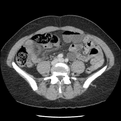 File:Closed loop small bowel obstruction due to trans-omental herniation (Radiopaedia 35593-37109 A 55).jpg