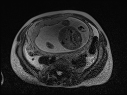 Closed loop small bowel obstruction in pregnancy (MRI) (Radiopaedia 87637-104031 D 14).jpg