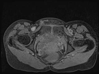 Closed loop small bowel obstruction in pregnancy (MRI) (Radiopaedia 87637-104031 F 70).jpg