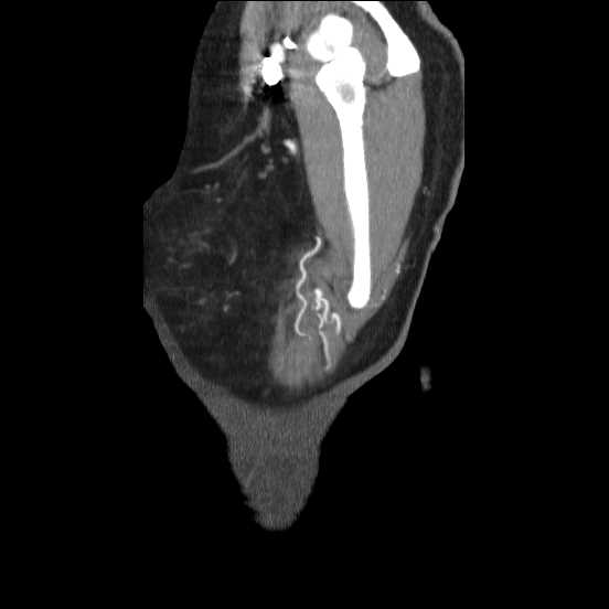 Coarctation of the aorta (Radiopaedia 67609-77010 C 1).jpg